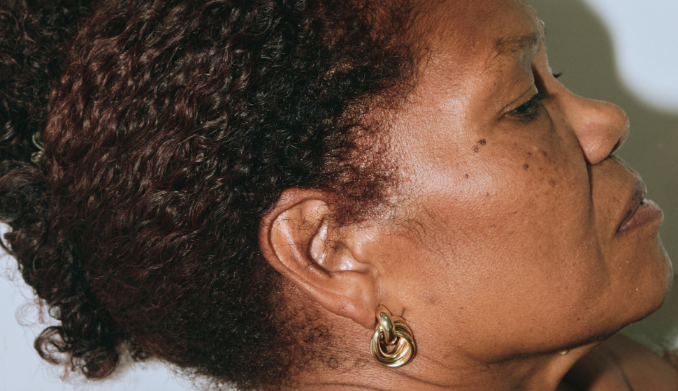 Get Rid of Dark Spots on Your Face  - Here’s How